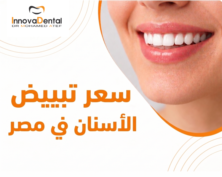 Teeth Whitening Price in Egypt: Best Offers
